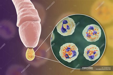 Gonorrhoea .